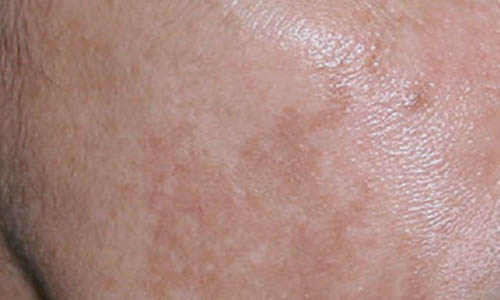 رایج ترین اشتباهاتی که سلامت پوست شما را در زمستان به خطر می اندازند