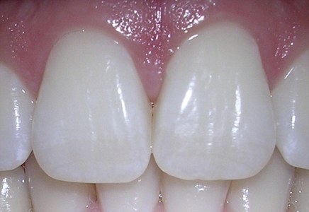 ابداع ماده ای که از ورود سرما و گرما به منطقه حساس دندان جلوگیری می کند