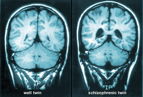 آشنایی با نوعی بیماری ذهنی که توهم و هذیان را در پی دارد/ نگاهی نزدیک به اسکیزوفرنی