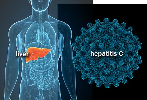 بیماری ساده ای که در صورت عدم درمان ممکن است به مشکل جدی تبدیل شود/ همه چیز در مورد هپاتیت C