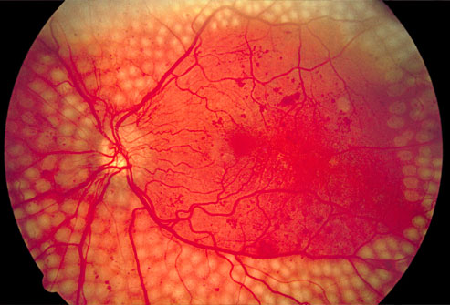 چگونه دیابت بر روی بینایی ما تاثیر می گذارد
