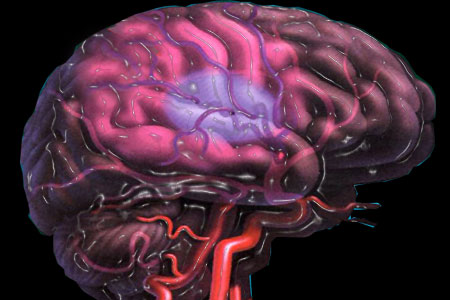 کلیدی ترین نکات و پاسخ به پرسشهای رایج در مورد «سکته مغزی»/ در مورد سکته مغزی چه میزان اطلاعات دارید؟