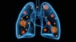 نانوذرات تلفات جانی در اثر التهاب ریه را کاهش می‌دهد