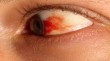 خونریزی چشم و راه درمان آن