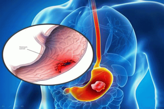 سرطان روده سالانه ۲ میلیون نفر را در دنیا درگیر می کند/ مصرف زیاد فست فودها ممنوع