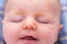 کلاهک گهواره، عارضه شایع پوستی در نوزادان