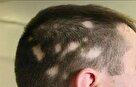 راه کارهایی مؤثر در درمان ریزش موی سکه ای