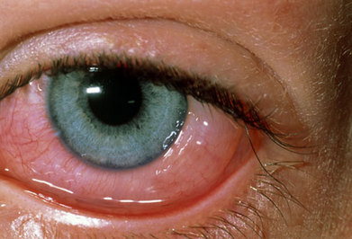 بیماری کراتیت, التهاب قرنیه چشم
