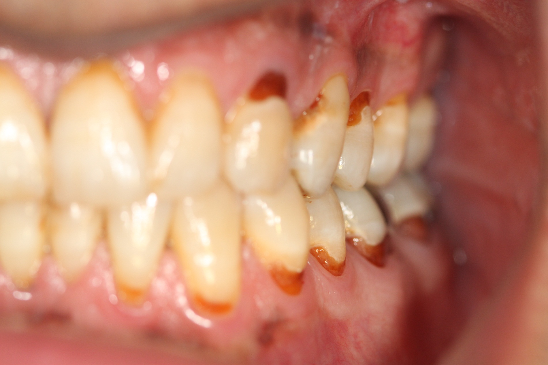 پوسیدگی دندان و بیماری‌های لثه بیش از 70 درصد جمعیت کشور را به خود مبتلا کرده اند