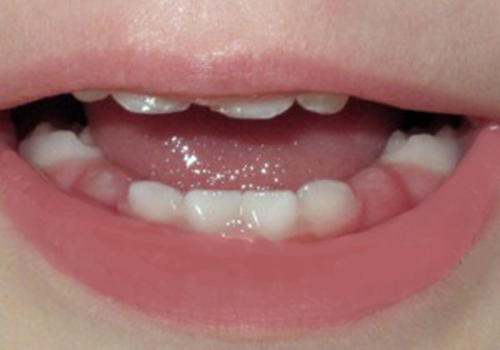 آشنایی کامل هیجان انگیزترین دوران رشد کودک دلبند شما/ مراحل رشد دندان کودک