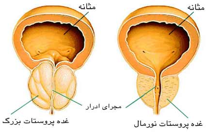 مردان استان های اصفهان و تهران بیشترین آمار ابتلا به سرطان پروستان را دارا هستند