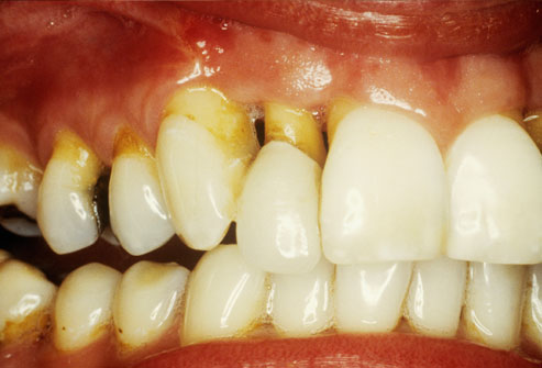 عواملی باعث حساس شدن دندان ها می شوند