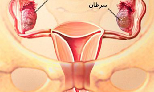 سرطان را جدی بگیرید و پیش از وقوع آن پیشگیری های لازم را انجام دهید/چگونگی پیشگیری از سرطان هایی که خانم ها را تهدید می کنند