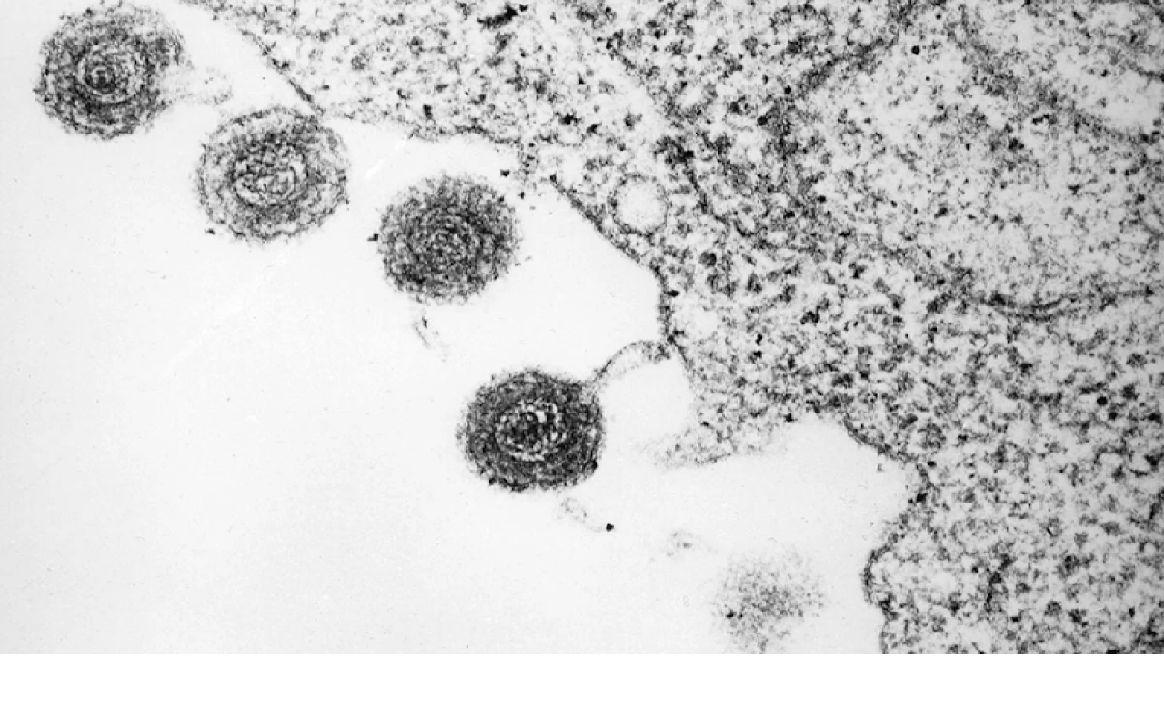 ویروس‌های نهفته باعث آلزایمر می‌شوند