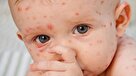 آبله مرغان چه علائمی دارد و از چه طریقی منتقل می‌شود؟