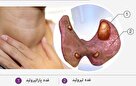 ایران سومین کشور دارای علم پیوند پاراتیروئید