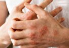 چه غذاهایی برای پسوریازیس مفید و ممنوع است؟