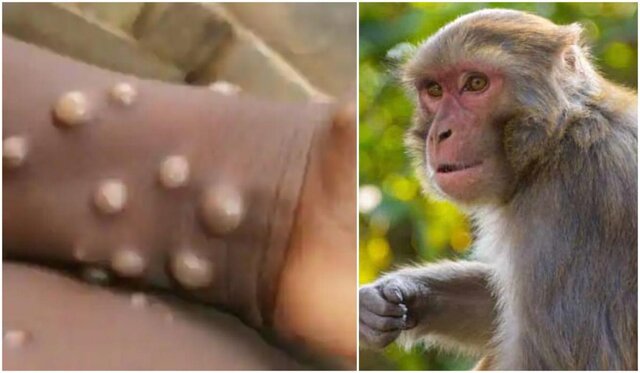 آبله میمونی، یک بیماری ناشناخته با علائمی خفیف