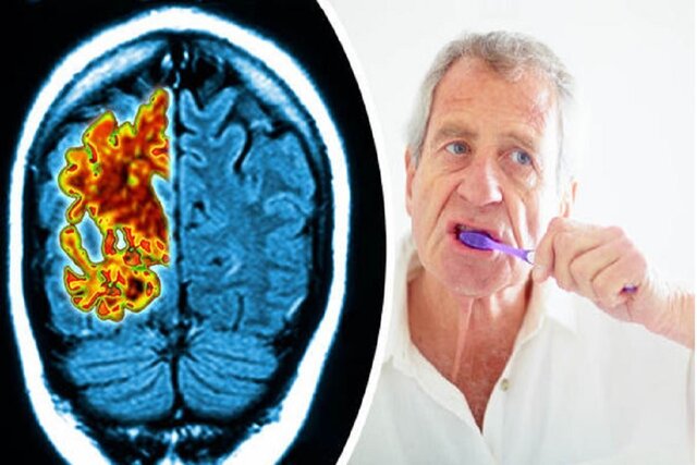 ارتباط ابتلا به آلزایمر با باکتری‌های دهان تایید شد