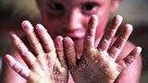 بیماران پروانه ای با چه مشکلاتی دست و پنجه نرم می کنند؟