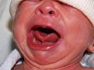 چسبندگی زبان به دهان اختلالی نادر و دردناک در کودکان