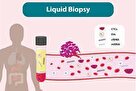 تشخیص زودهنگام بیماری‌ها با بیومارکرهای مایع (Liquid Biopsy)